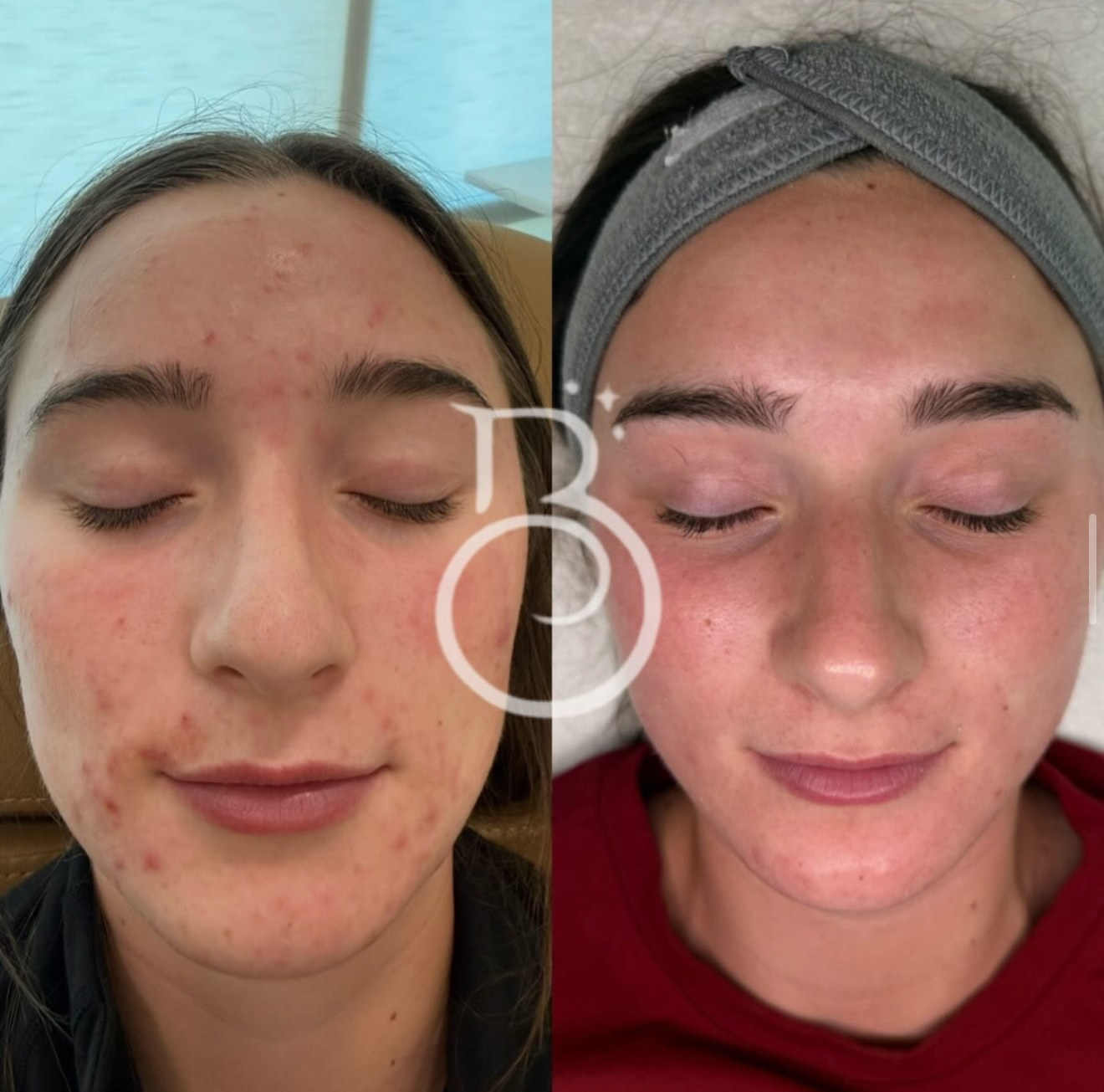 Before-and-after acne treatment result