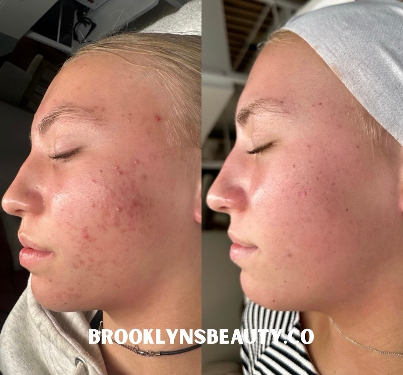 Before-and-after facial skin result shown in side profile