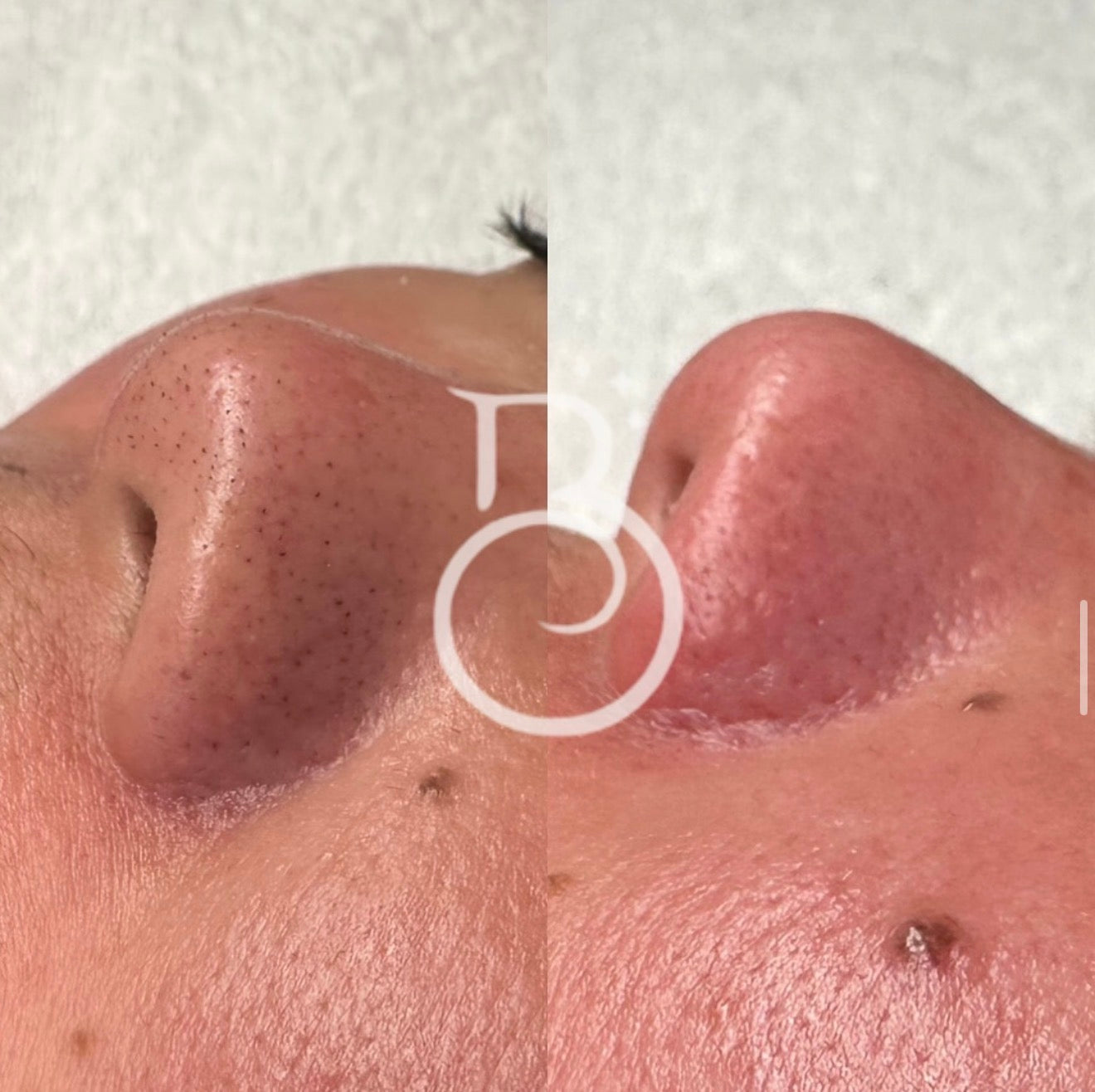Before-and-after skin texture improvement